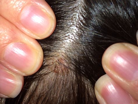 What Are Large Bumps On Head at Felipa Hunter blog