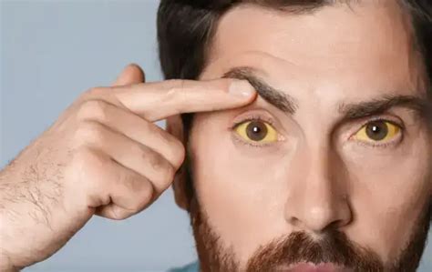 What Causes of Yellow Eyes