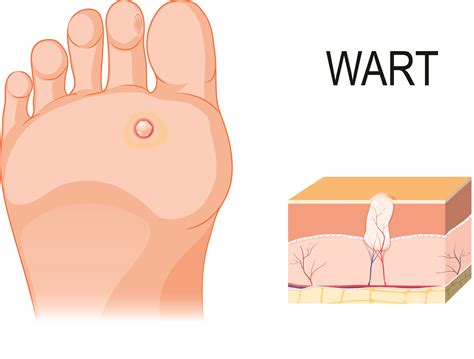 Plantar Warts | Podiatrists, Foot and Ankle Specialists & Diabetic Foot Care Specialists located ...