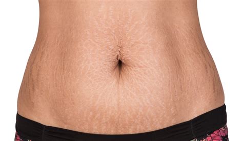 Cellulite On Stomach