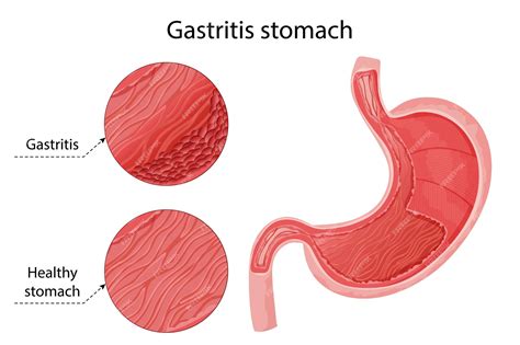 Infografía de comparación de gastritis y estómago sano | Vector Premium