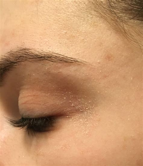 [misc] Recommendations for dry flaky skin around eyes : r/SkincareAddiction