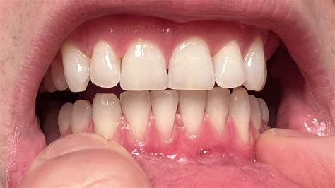 Are my lower gums receding? How bad is it? : r/DentalHygiene