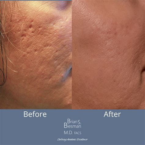 Face Laser For Acne Scars at Sarah Bugarin blog
