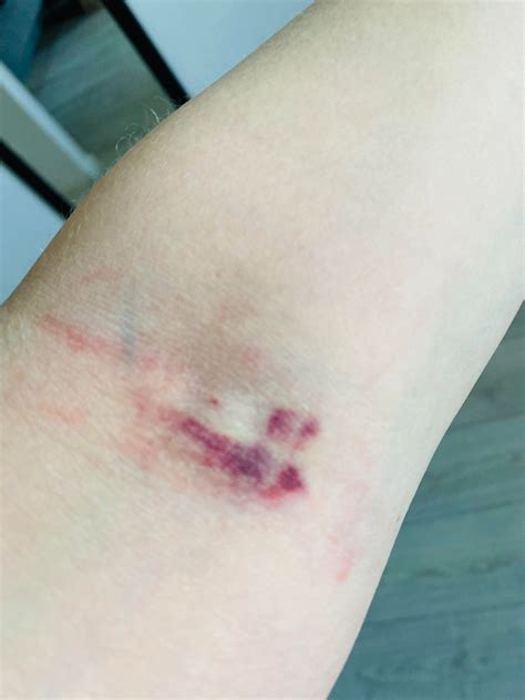 Kate Knowler on LinkedIn: Bruising or haematoma after a blood draw is NOT a normal outcome, and ...