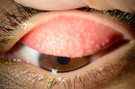 Giant Papillary Conjunctivitis