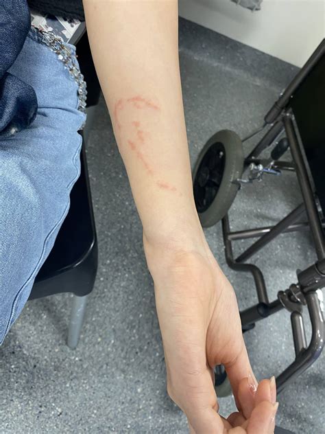 Blue Bottle Jellyfish • LITFL • Toxicology Library