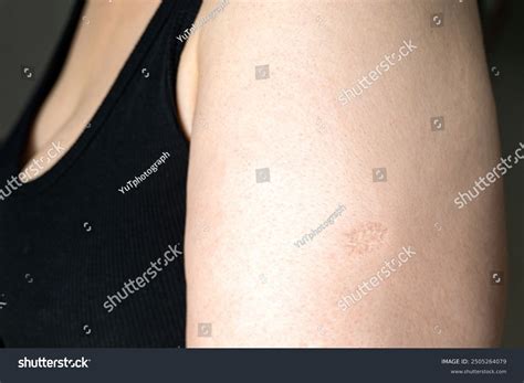Bcg Tb Vaccine Scar Marks Monkeypox Stock Photo 2505264079 | Shutterstock