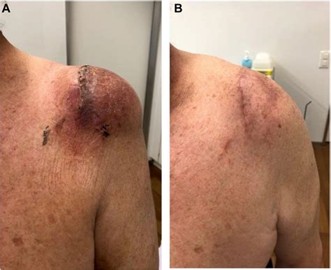Hematoma After Surgery