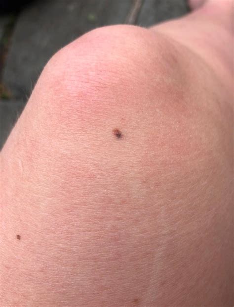 Mole turned into stage 3 melanoma in a month