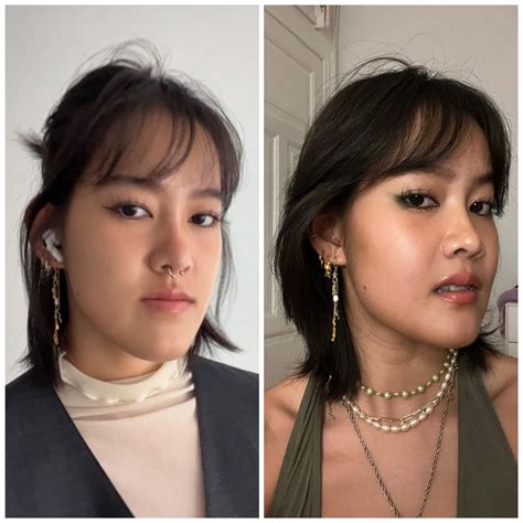 1 month post op with pics (double jaw surgery for underbite), no regrets! : r/jawsurgery