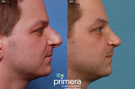Rhinoplasty Before and After Pictures Case 21 | Orlando, Florida | Primera Plastic Surgery