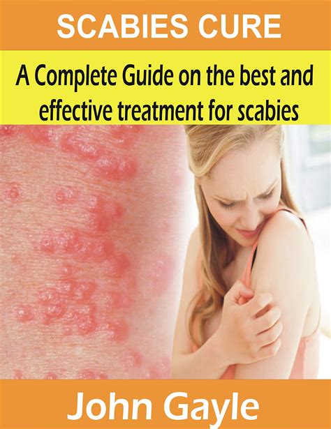 SCABIES CURE: A Complete Guide on the Best and effective treatment for scabies by John Gayle ...