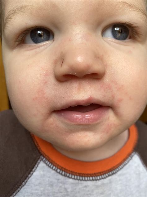 Perioral Dermatitis In Children