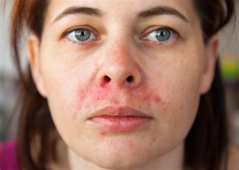 Facial eczema : understanding causes, treatment, and care