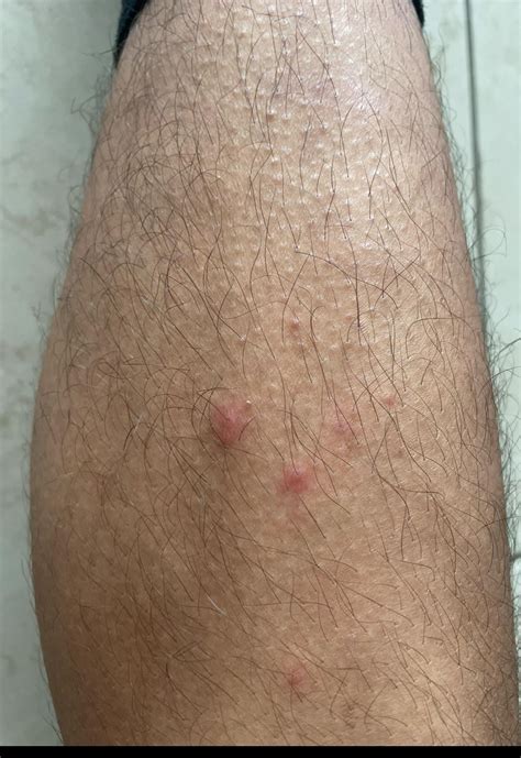 Unknown Red Bumps On Legs : r/DermatologyQuestions