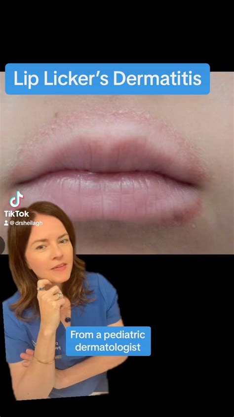 Sheilagh Maguiness | Lip, licker’s dermatitis! Lip licker’s dermatitis ...