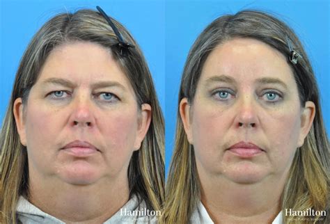 Photo Gallery | Hamilton Facial Plastic Surgery