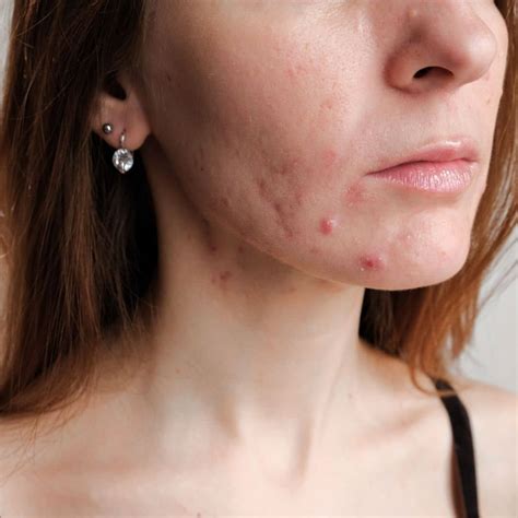 Does Stress Cause Acne? - Advanced Skin and Laser Center