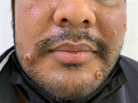 Mpox vs. Chickenpox: Symptoms, Causes, and Treatment