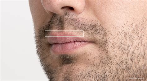 Fordyce Spots – Integricare Dermatology