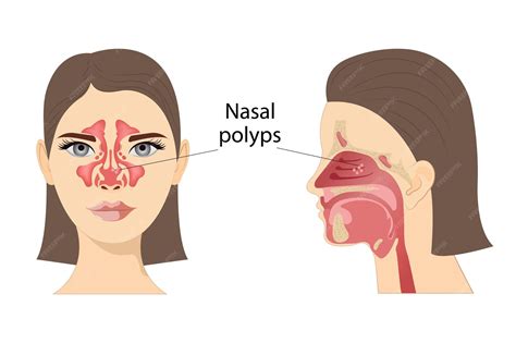 Premium Vector | Medical vector illustration of nasal polyps ...