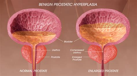 Benign Prostatic Hypertrophy Surgery