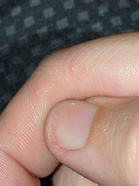 Single itchy bump on finger? : r/medical