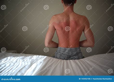 Face Itching From Sunburn at Todd Briggs blog