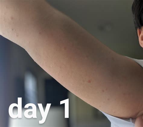 Amoxicillin rash progression : r/DermatologyQuestions