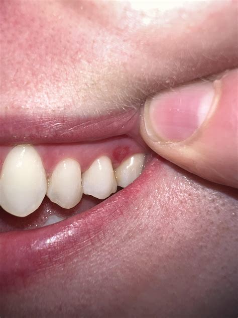 Is this a canker sore? : r/CankerSores