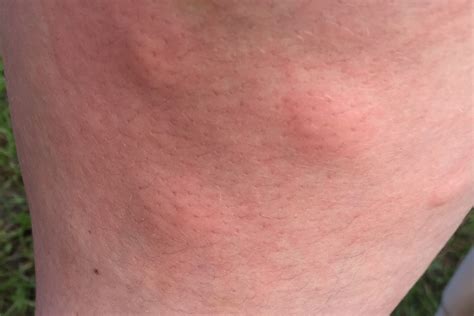 Leg Swollen From Bug Bite at Mickey Munos blog