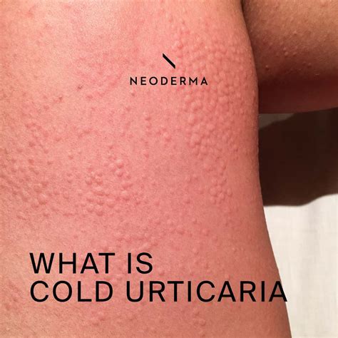 What is Cold Urticaria – NEODERMA