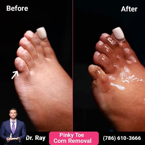 Permanent Callus and Corn Removal Surgery