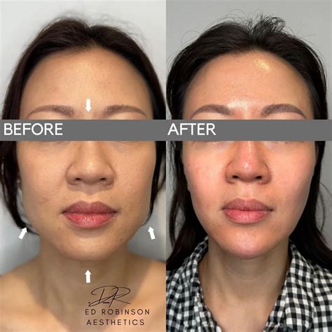 Masseter Botox Transform Your Jawline: Masseter Botox Benefits