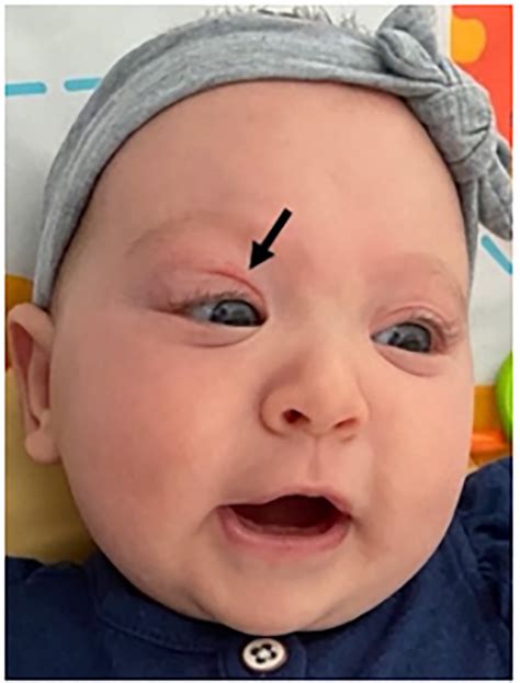 Case of an Infant with Intermittent Eye Swelling - PMC
