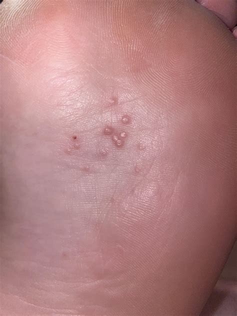 Bumps On Bottom Of Foot