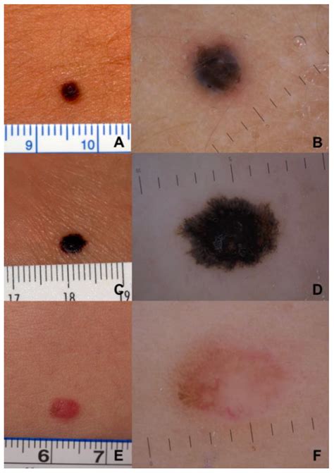 Melanoma Child at Martha Holt blog
