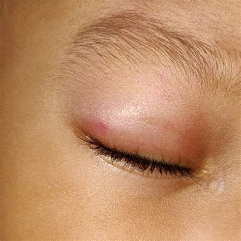 Bed Bug Bites On Eyelid