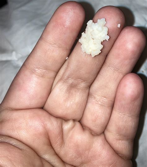 If your discharge looks chunky, cottage cheese looking (even with no ...