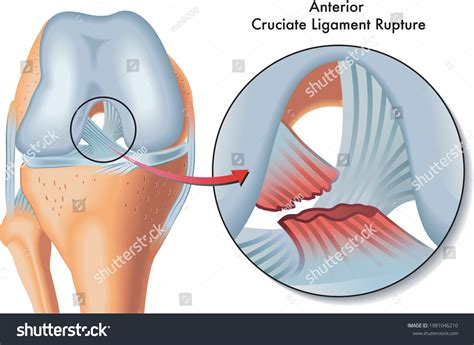 Posterior And Anterior Cruciate Ligament
