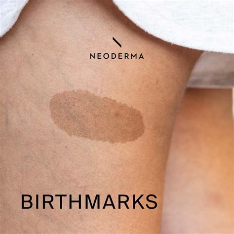 Birthmarks | Birthmark, Skin discoloration, Blood vessels
