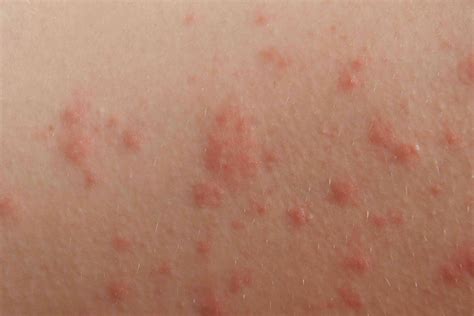 Itchy Rash On Bum Cheeks Child