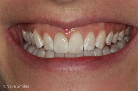 Single dark tooth (dead tooth) — Nova Smiles