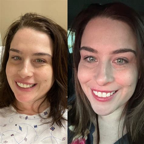 SIPS/SADI/LDS Versus Sleeve--What's the Difference | Find Surgical ...