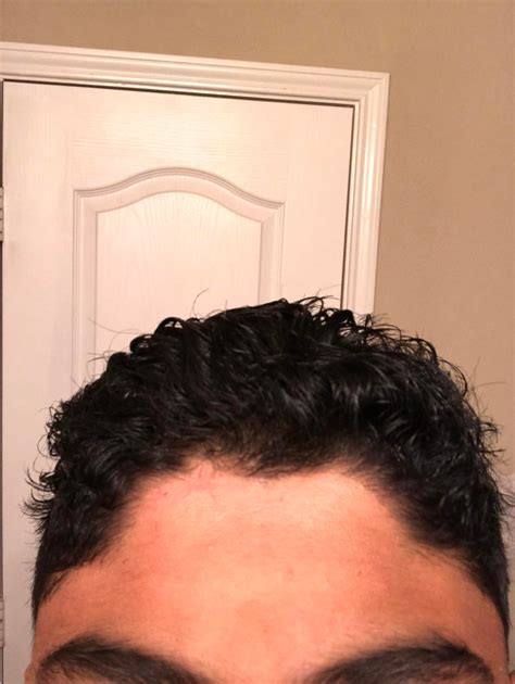15, male, why is my hairline so messed up? What are some good styles to ...