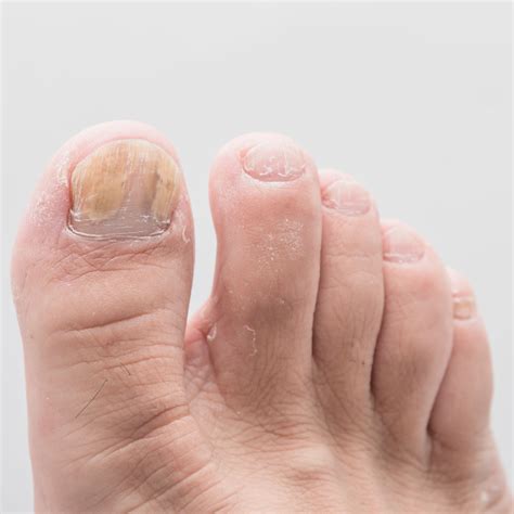 Toenail Bruise No Pain at Darrel Ferreira blog