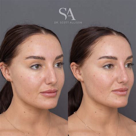 Non-Surgical Rhinoplasty Brisbane - Nose Filler - Dr Allison
