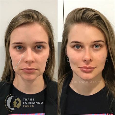 Before/after facial transformation with dermal filler. What do you think? Comment ⬇️ . . This ...