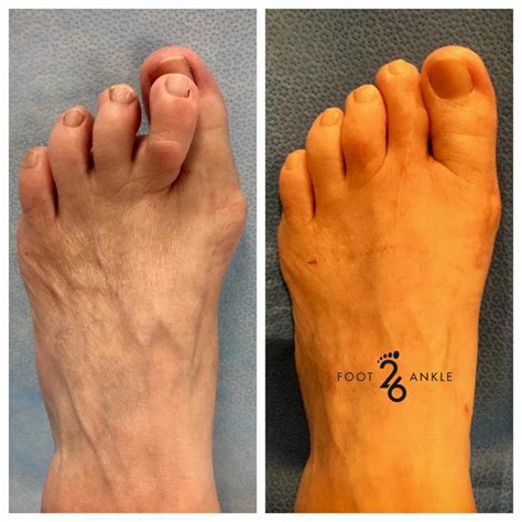 Toe Surgery Hammertoe